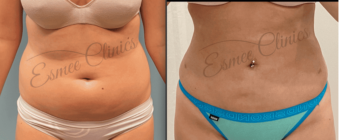 Before and After img